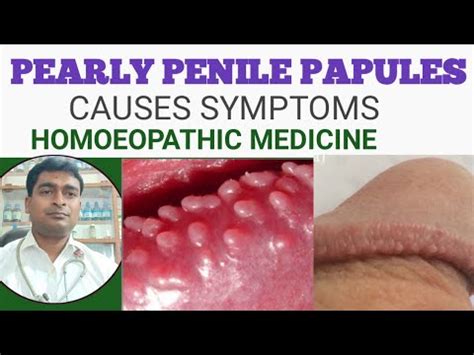 Penile Pearly Papules: Multiple white papules on the penis